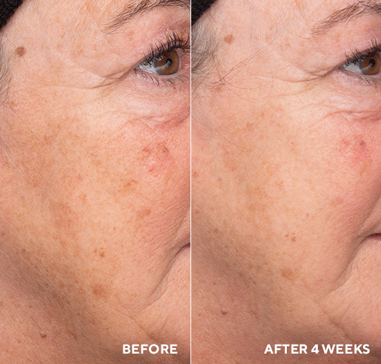 Liquid Resurfacing Solution &ndash; Щоденний незмивний лосьйон-ексфоліант з 2% саліцилової кислоти 1004 фото